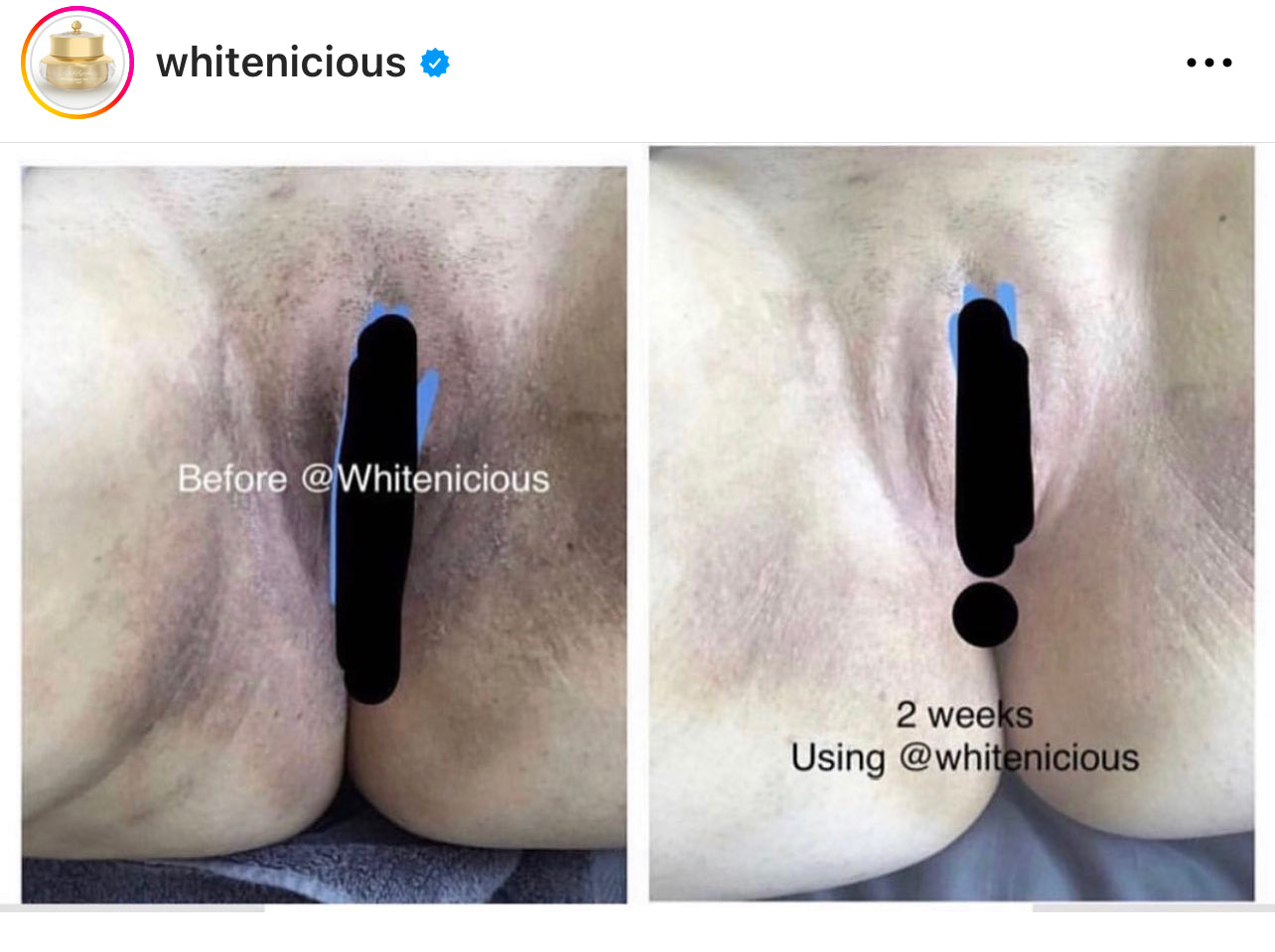 Vagina, Nipples, Anal Bleaching Cream Blac Chyna 15ml | 70ml