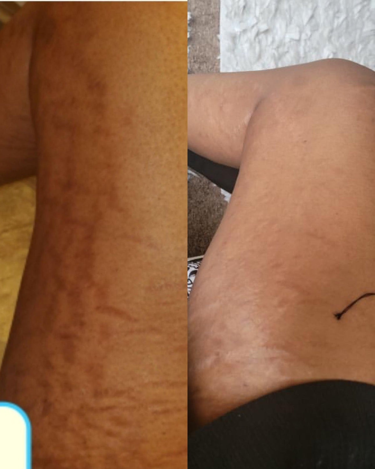 SCARRING (SURGERY, OLD, & BURN MARKS)