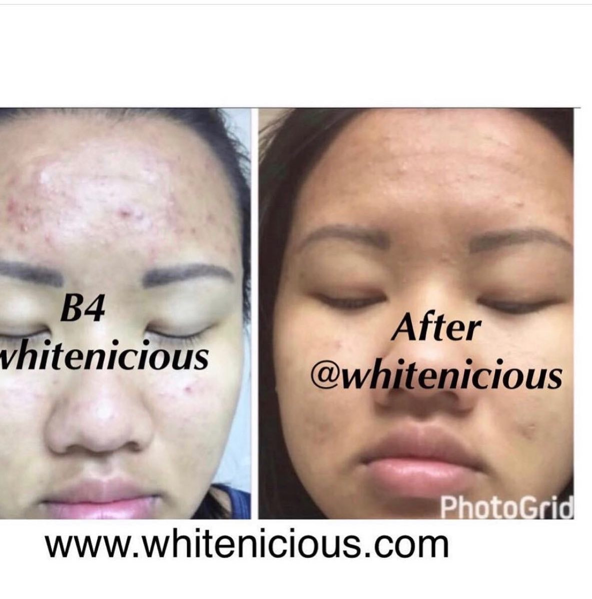 Dark Spot Eraser system